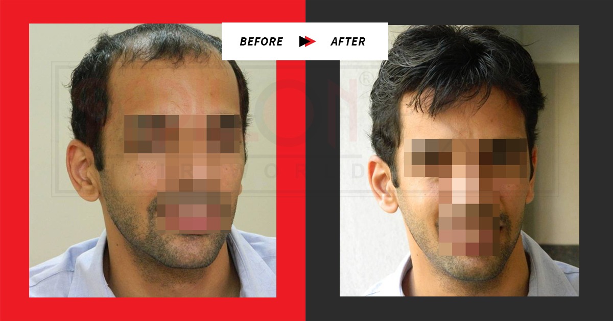 Testimonial Swaroop Before & After : Hair Loss Treatment