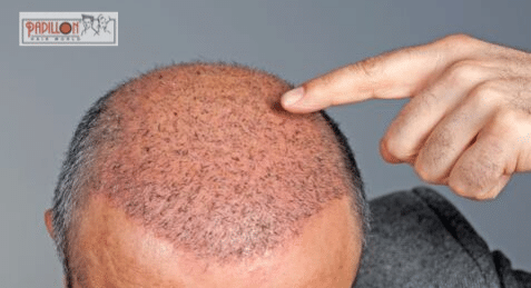 Worried about Hair transplant cost?