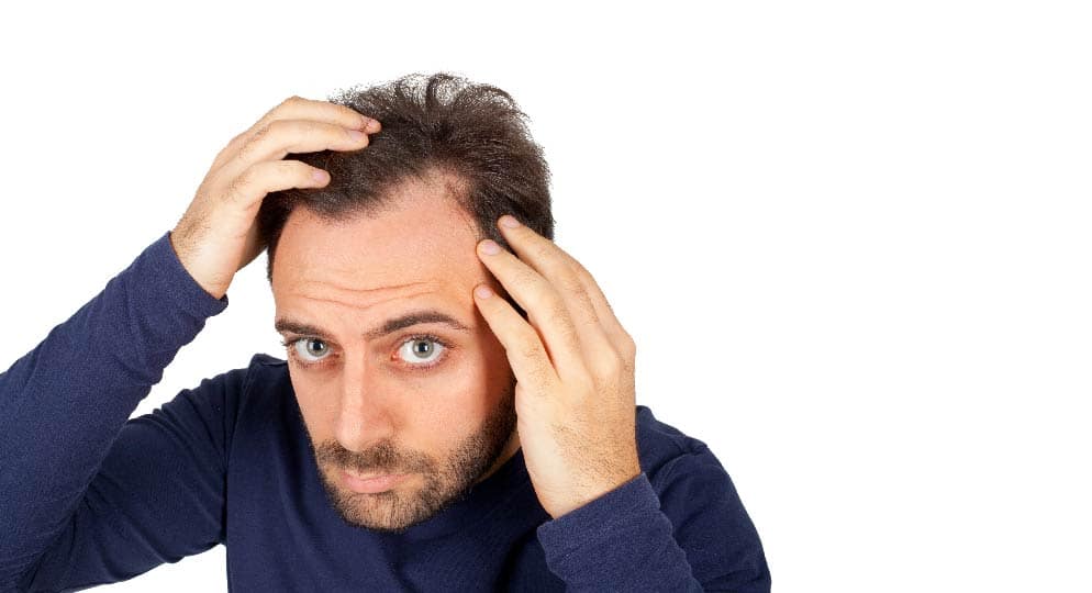 Causes of Male Baldness & treatment – Papillon Hair World